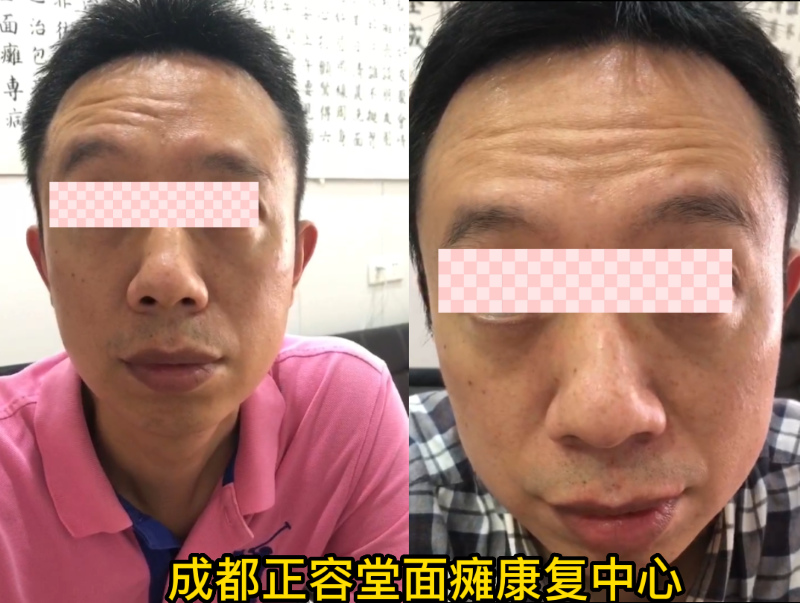 康复病例