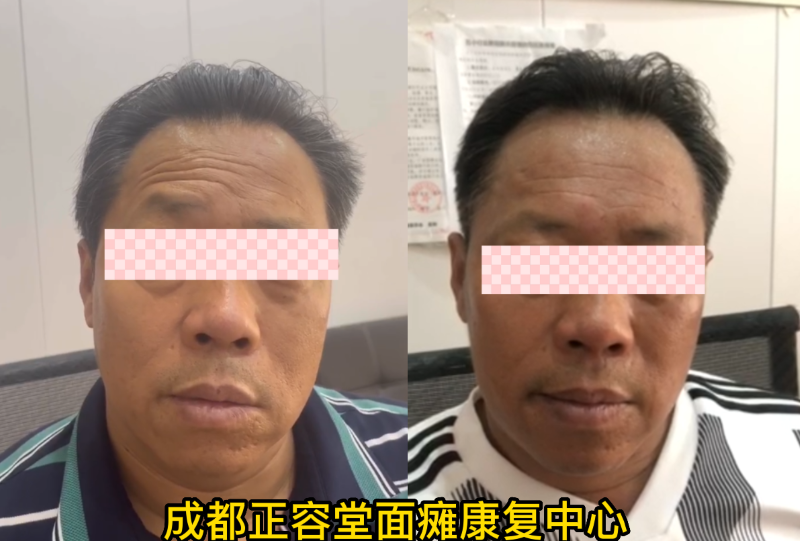 康复病例