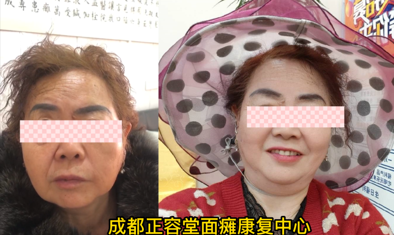 康复病例