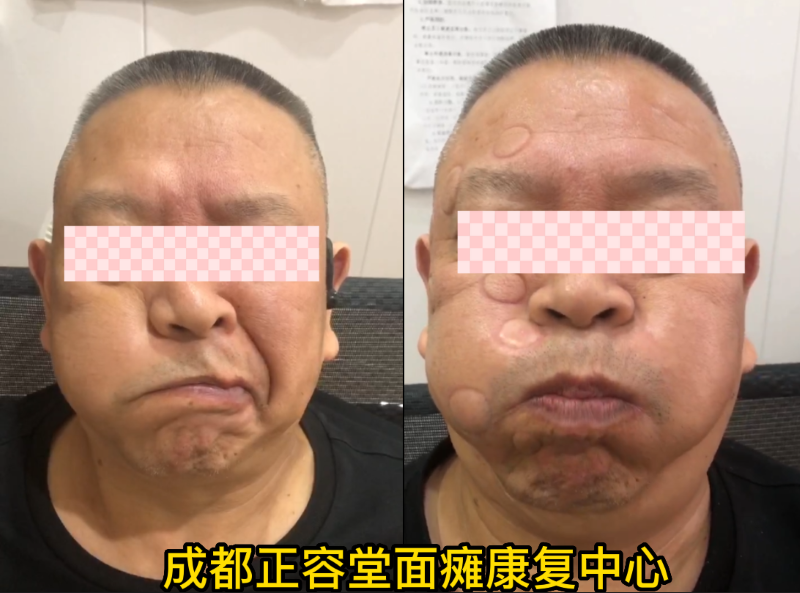 康复病例